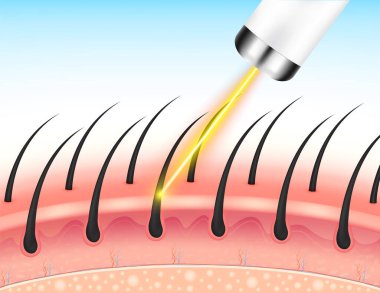 Lazerle alınması istenmeyen tüyleri aldırmak deriyi pürüzsüz yapar. Tıbbi güzellik konsepti. 3D gerçekçi vektör EPS10. Gümüş etiketler ürün etiketi tasarımı için kullanılır.