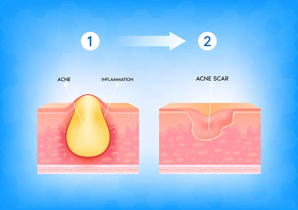 Inflammerad Akne Huden Inflammation Samband Med Finnar Strukturen Huden Akne — Stock vektor