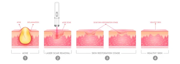 痤疮疤痕血管激光治疗 与粉刺有关的炎症 皮肤痤疮疤痕的结构 医疗美容护肤理念 3D矢量插图 — 图库矢量图片