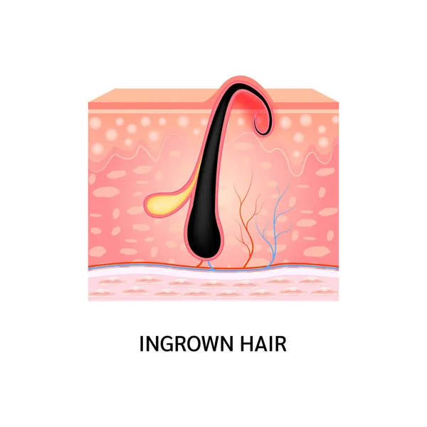 Cheveux Incarnés Les Cheveux Sont Redevenus Surface Peau Après Rasage — Image vectorielle