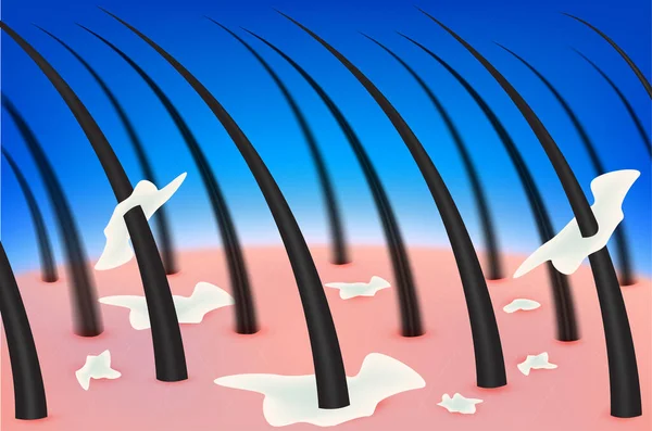 Saç kepeği ve kafa derisi. Dermatit, bakteri, mantar ya da başındaki sivilcelerden kaynaklanır. İnsan derisinin katmanları. Tıbbi güzellik konsepti. 3 boyutlu gerçekçi vektör. Güzellik kliniği reklamlarında kullanılır..