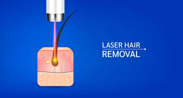 Laserové Odstranění Vlasů Nežádoucí Aby Pokožka Hladká Koncept Lékařské Krásy — Stockový vektor