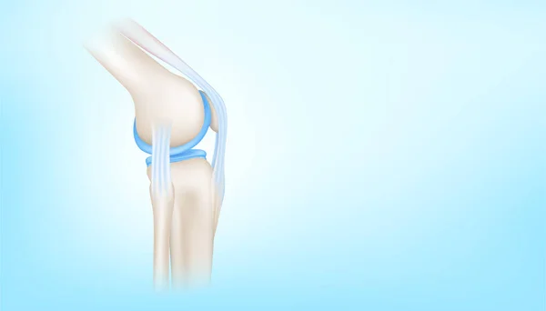 Articulación Rodilla Con Lado Sano Del Cartílago Sobre Fondo Azul — Vector de stock