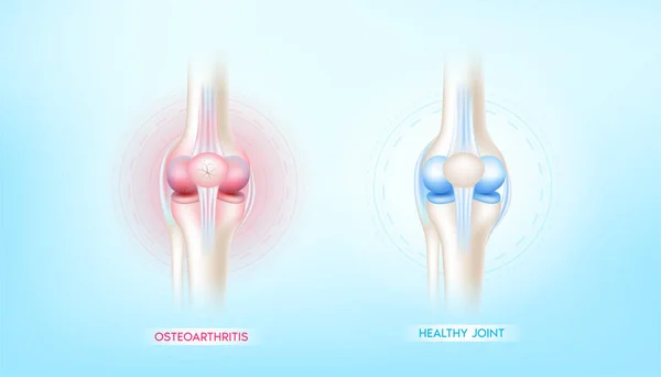 다리와 건강하게 관절염 인간의 구조는 치료에 손상을 줍니다 스켈턴 개념입니다 — 스톡 벡터