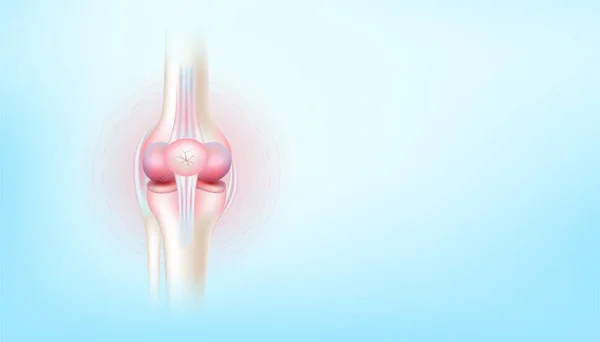 Arthrite Articulation Genou Cartilage Côté Arthrose Sur Fond Bleu Avec — Image vectorielle