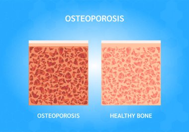 Kemik erimesi aşamaları. Kemik yapısı ve osteoporoz normal. Sağlık konseptini kontrol et. Mavi arka planda izole edilmiş. Vektör EPS10 illüstrasyonu.