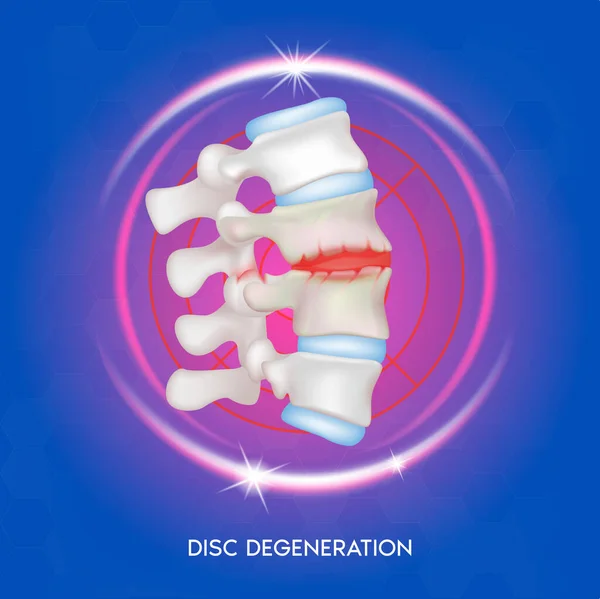 Degeneração Disco Doenças Coluna Vertebral Discos Ossos Intervertebrais Anatomia Das —  Vetores de Stock