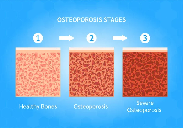 Osteoporos Benstruktur Normal Och Osteoporos Medicinsk Kontroll Upp Hälsa Koncept — Stock vektor
