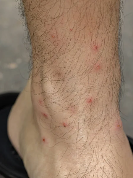 Pés Humanos Com Várias Reações Alérgicas Picadas Carrapatos Com Foco — Fotografia de Stock