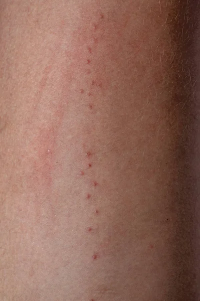 Human Skin Various Allergic Reactions Tick Bites Selective Focus — Stockfoto