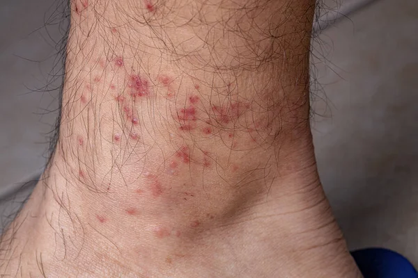 Human skin with various allergic reactions to tick bites with selective focus