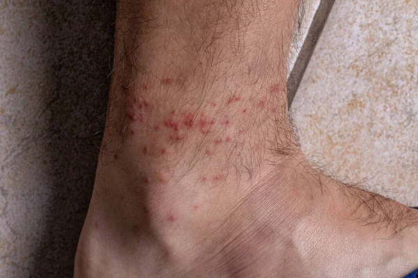 Ludzka Skóra Różnymi Reakcjami Alergicznymi Ugryzienia Kleszczy Selektywnym Ukierunkowaniem — Zdjęcie stockowe