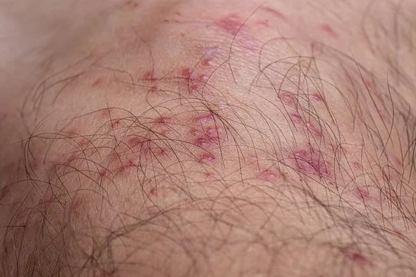 Human skin with various allergic reactions to tick bites with selective focus