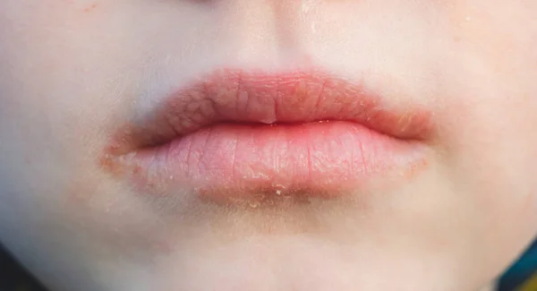 Dudaklarında kangren var. İltihaplı dudak derisi hastalıkları ve dermatoloji