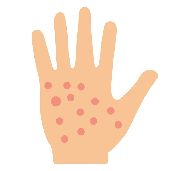 Ekzeme Hand Haut Symbol Auf Weißem Hintergrund Symbol Der Allergischen — Stockvektor