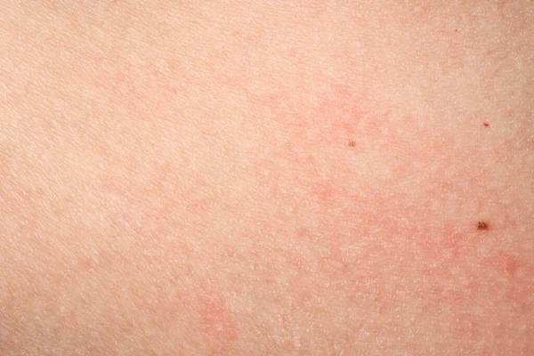 Huid Met Acne Met Rode Vlekken Gezondheidsproblemen Huidziekten Sluit Allergie — Stockfoto