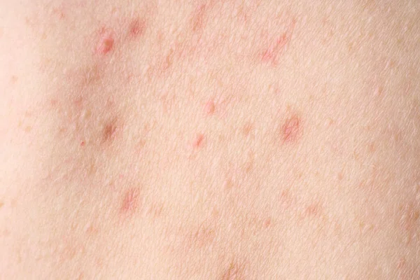 Skin with acne, with red spots. Health problem, skin diseases. Close up Allergy rash. Dermatitis problem of rash.