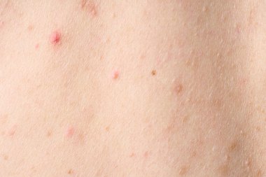 Sivilceli cilt, kırmızı lekeli. Sağlık sorunları, deri hastalıkları. Alerji isiliğini kapat. Dermatit sorunu.. 