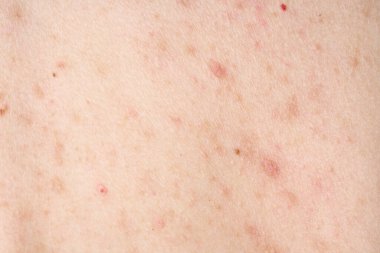 Sivilceli cilt, kırmızı lekeli. Sağlık sorunları, deri hastalıkları. Alerji isiliğini kapat. Dermatit sorunu.. 