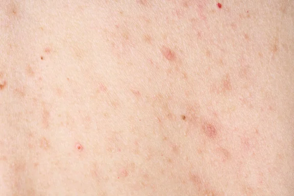Skin with acne, with red spots. Health problem, skin diseases. Close up Allergy rash. Dermatitis problem of rash.