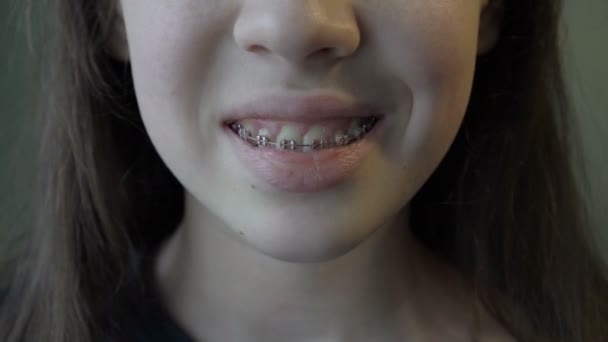 Close-up van een kindermond met beugel. Een tienermeisje glimlacht en toont metalen beugels in haar mond. 4K — Stockvideo