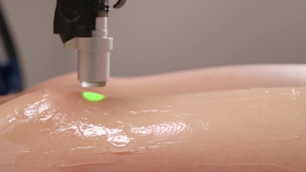 Laserowa depilacja nóg. — Wideo stockowe