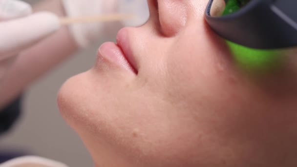 Laserowa depilacja twarzy. — Wideo stockowe