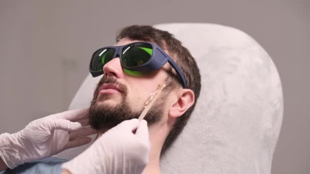 Laser-Enthaarung der Bartkontur. — Stockvideo
