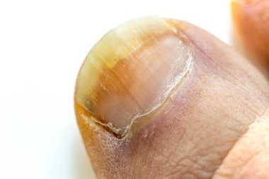 onychomycosis, The initial stage of mycosis. Big toe infected with fungal bacteria, Close up, White background