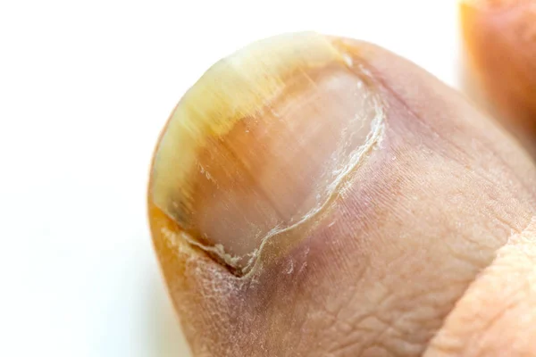 Onychomycosis Initial Stage Mycosis Big Toe Infected Fungal Bacteria Close —  Fotos de Stock