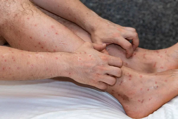 Brazos Piernas Picados Por Insectos Sedientos Sangre Países Tropicales Rascacielos —  Fotos de Stock