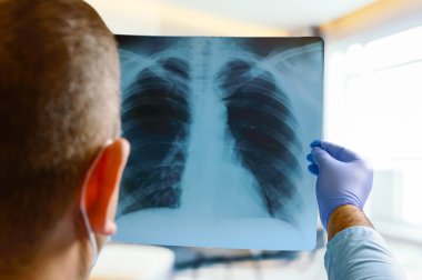 Doctor reading a chest x-ray in a hospital, close-up.