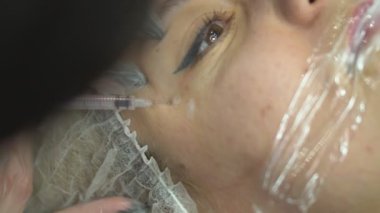 Facial injection procedure. Plastic surgery. Blockage of facial muscles. Wrinkle smoothing by injection. Facial rejuvenation procedure.