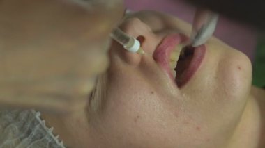 Lip injection procedure. Plastic surgery. Lip contouring procedure. Filler injection for lip augmentation. The process of creating aesthetically beautiful lips.