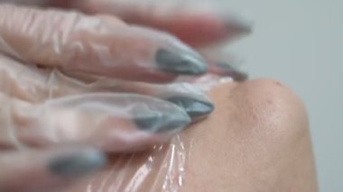 Lip injection procedure. Plastic surgery. Lip contouring procedure. Filler injection for lip augmentation. The process of creating aesthetically beautiful lips.