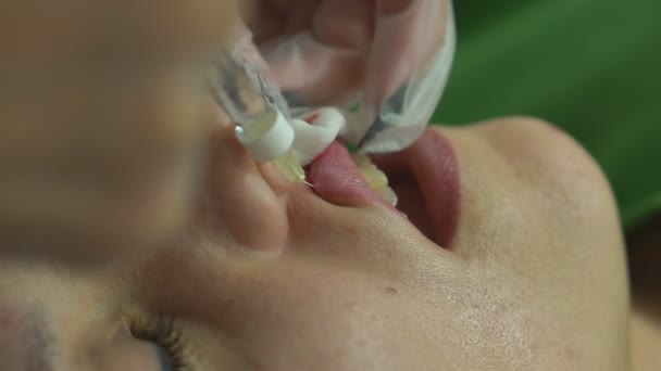Lip Injection Procedure Plastic Surgery Lip Contouring Procedure Filler Injection — Stock video