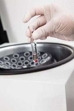 Santrifüjden sonra elde edilen kemik iliği hücreli test tüpü. Bilim adamı laboratuvarda akış sitometrik analizi için kemik iliği örnekleri hazırlıyor..