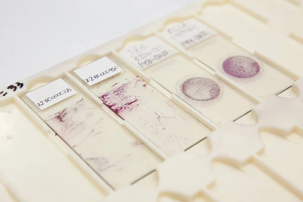 Traditional and liquid based cytology microscope slides for pap smear test. Cervical cancer concept. Medical concept.