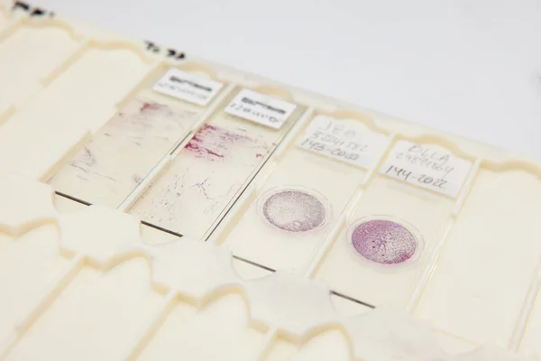 Traditional and liquid based cytology microscope slides for pap smear test. Cervical cancer concept. Medical concept.