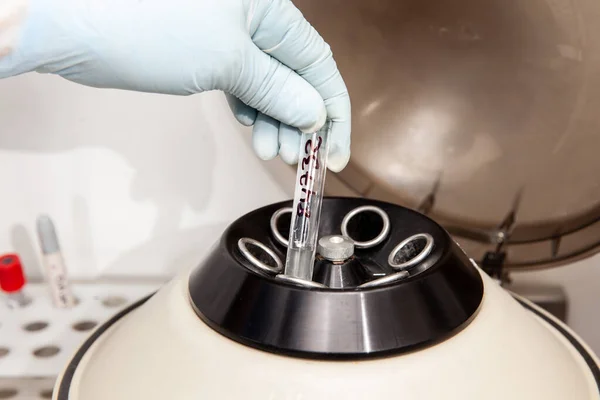 Scientist Preparing Peritoneal Fluid Sample Cytology Analysis Laboratory Cancer Diagnosis — Stock Photo, Image