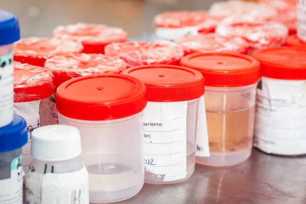 Sterile medical containers with biopsy samples ready to be processed at the pathology for analysis. Cancer diagnosis concept. Medical concept.