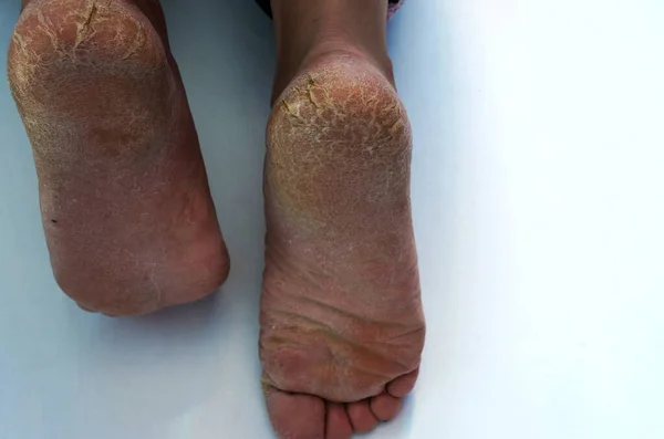 Extremely dry feet showing cracked heel in woman