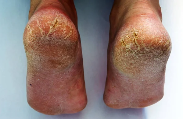 Extremely Dry Feet Showing Heel Deep Cracks Fotos de stock