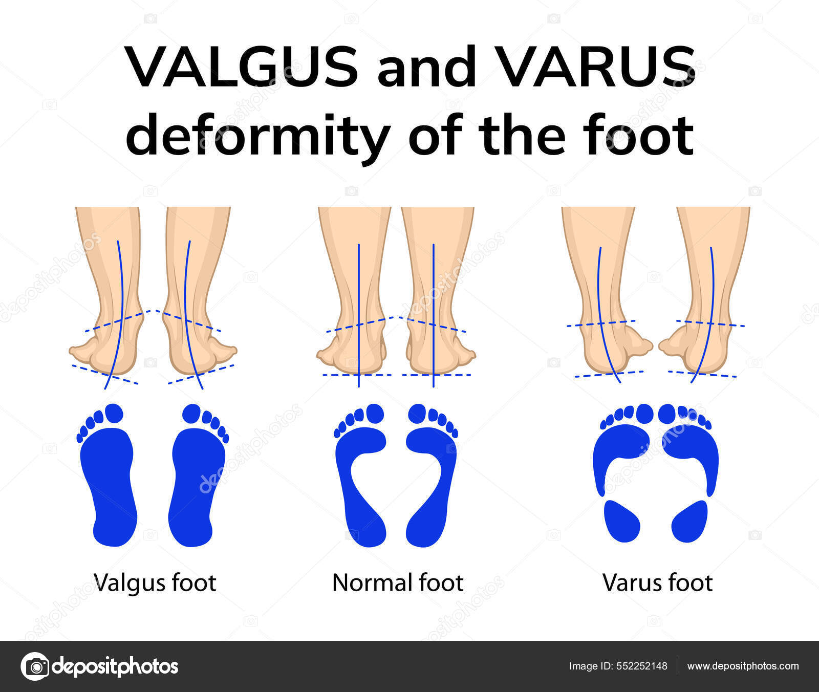 Illustration Position Des Pieds Dans Les Difformités Varus Valgus ...