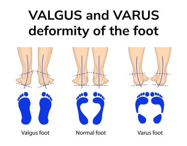 Varus ve valgus deformasyonlarında ayakların pozisyonu. İfade etmek, ayakların dikiz görüntüsü ve ayakların izidir.
