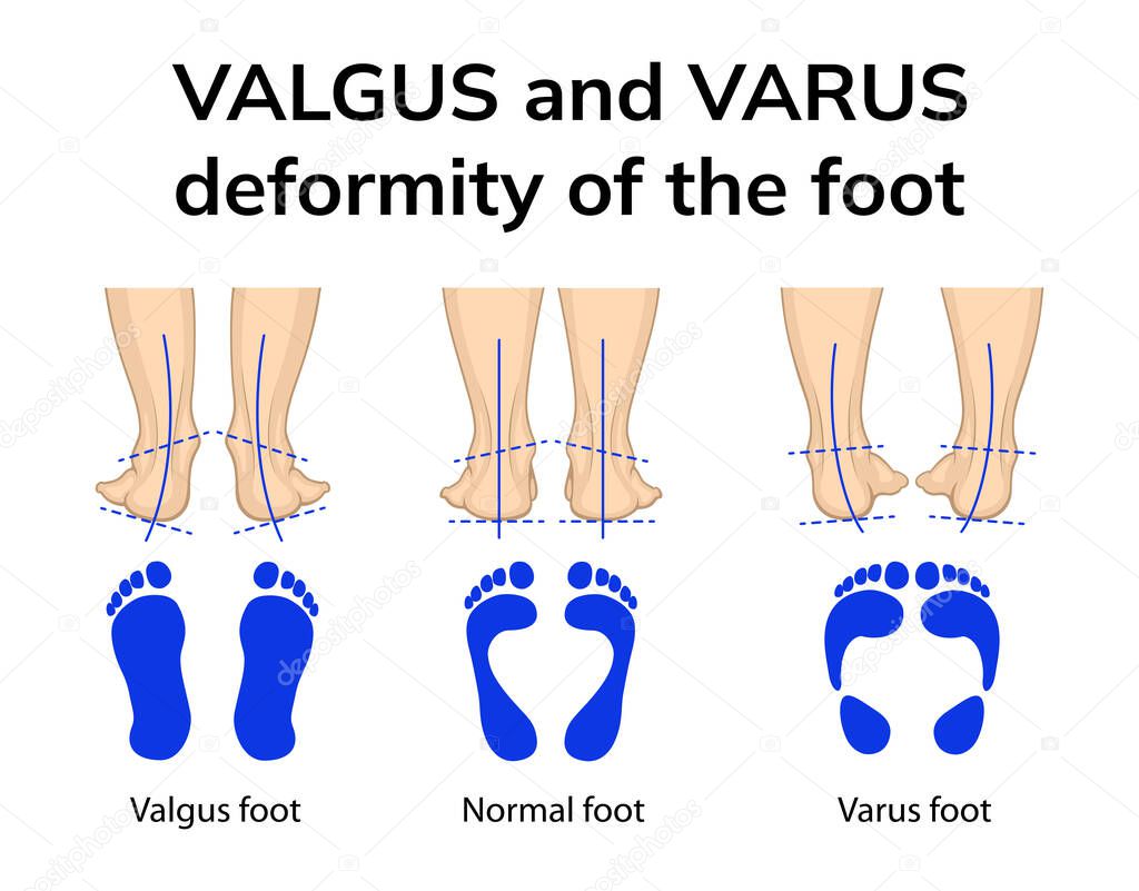 Ilustración de la posición de los pies en deformidades varo y valgo