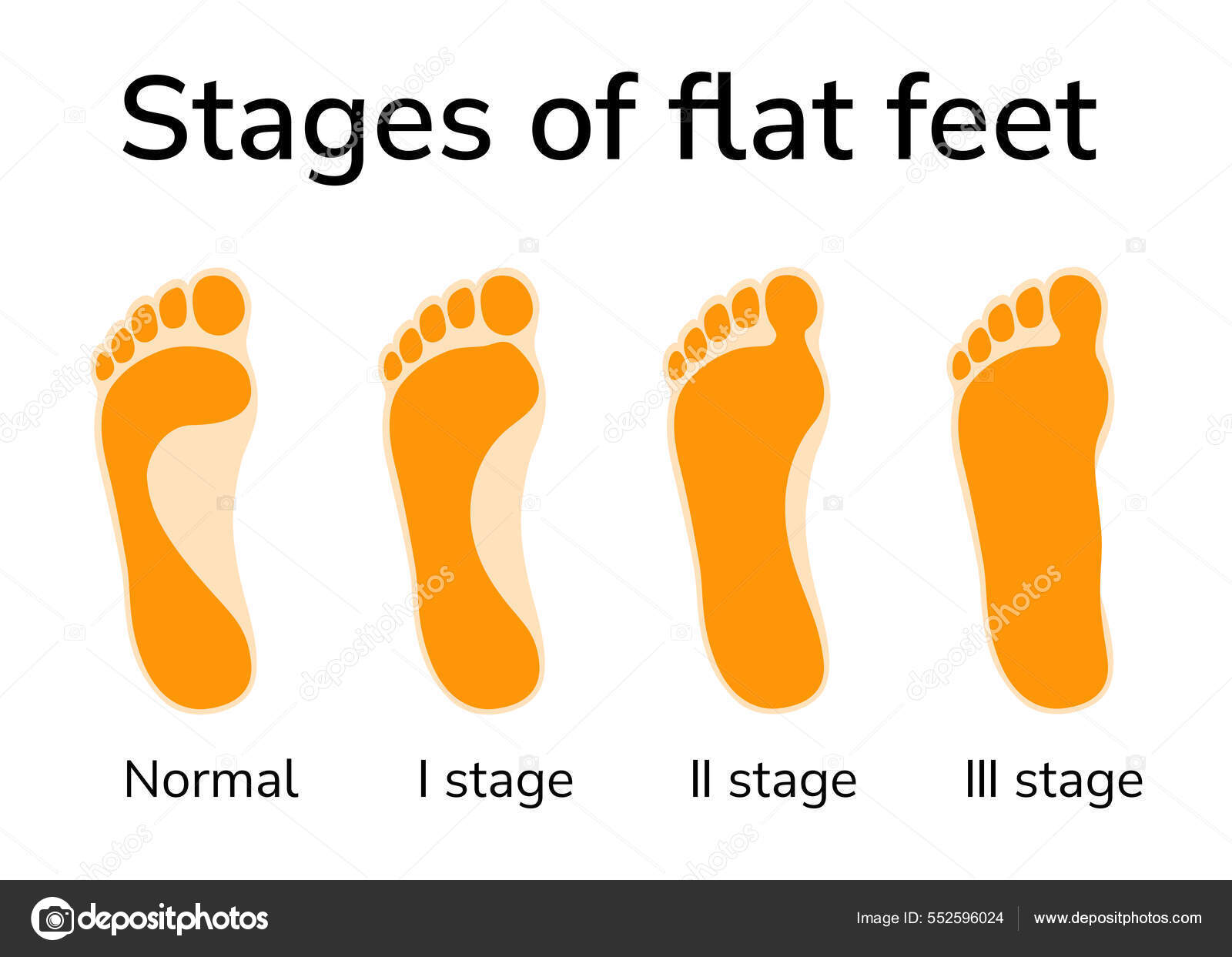 Ilustrasi Dari Tiga Tahap Kaki Datar Empat Jejak Kaki Digambarkan