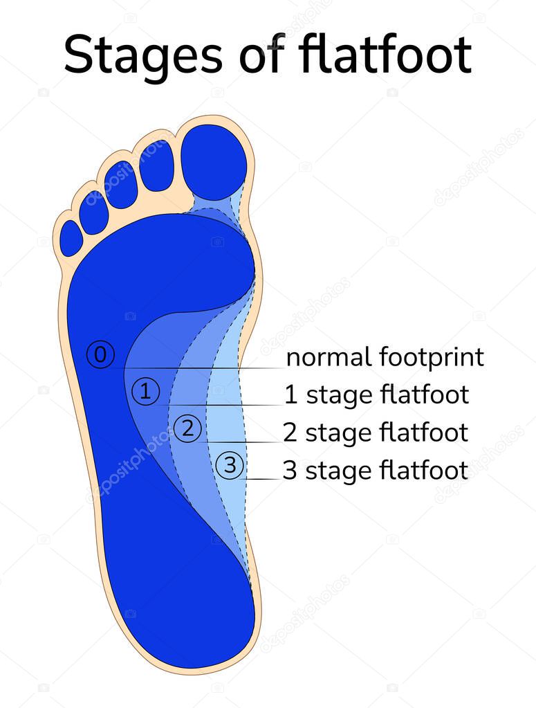 Illustration of the progression stage of flat feet.Different stages of flat feet are superimposed on the image of the imprint of a healthy foot. 