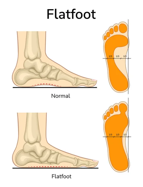 Ilustração Normal Plano Deslocamento Ossos Com Pés Chatos Pegada Com Ilustração De Bancos De Imagens