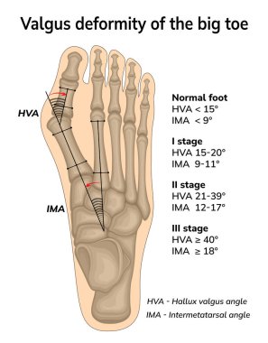 Illustration of valgus deformity of the big toe. The angles of bone displacement during deformation are shown clipart